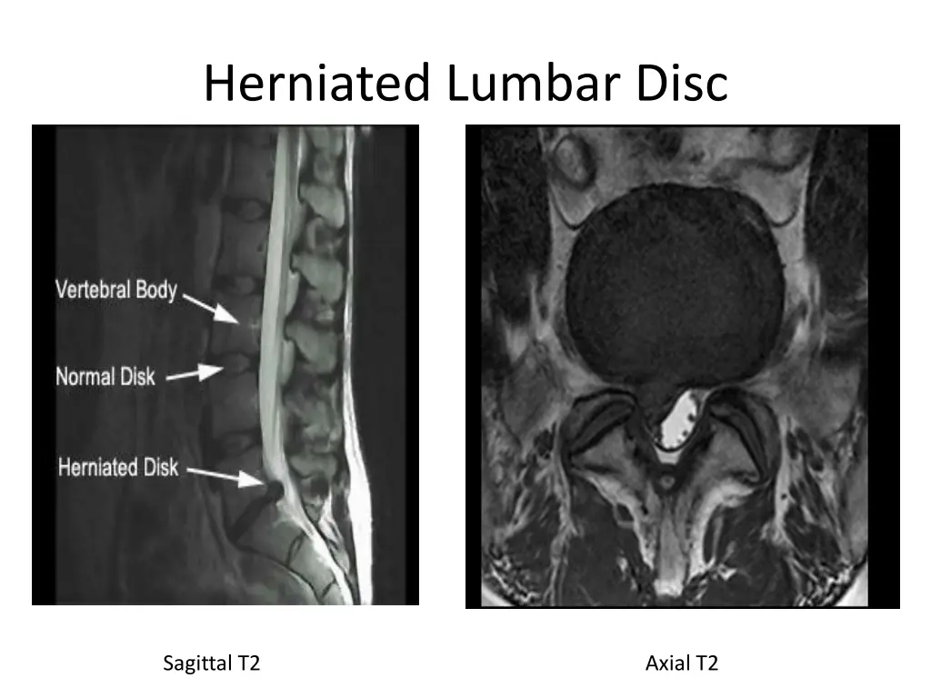 herniated lumbar disc