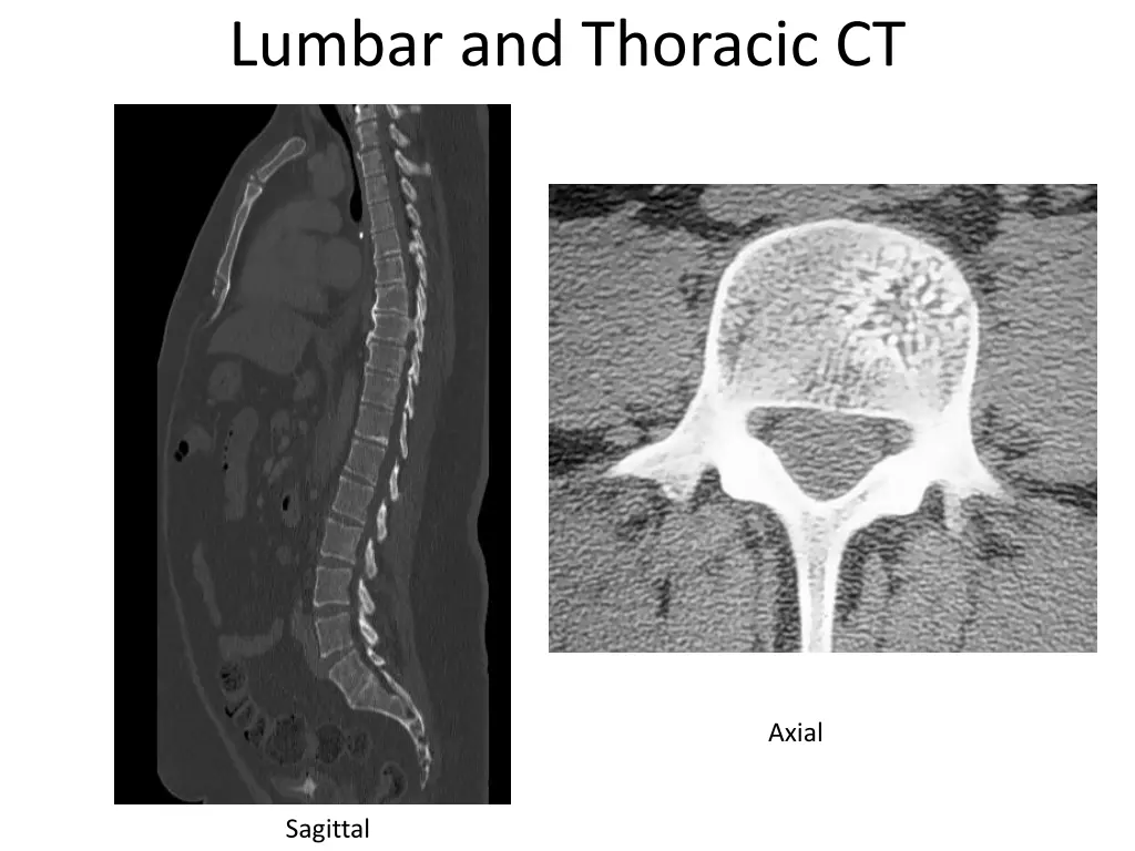 lumbar and thoracic ct