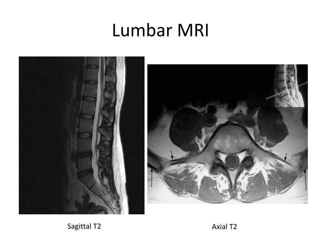 lumbar mri