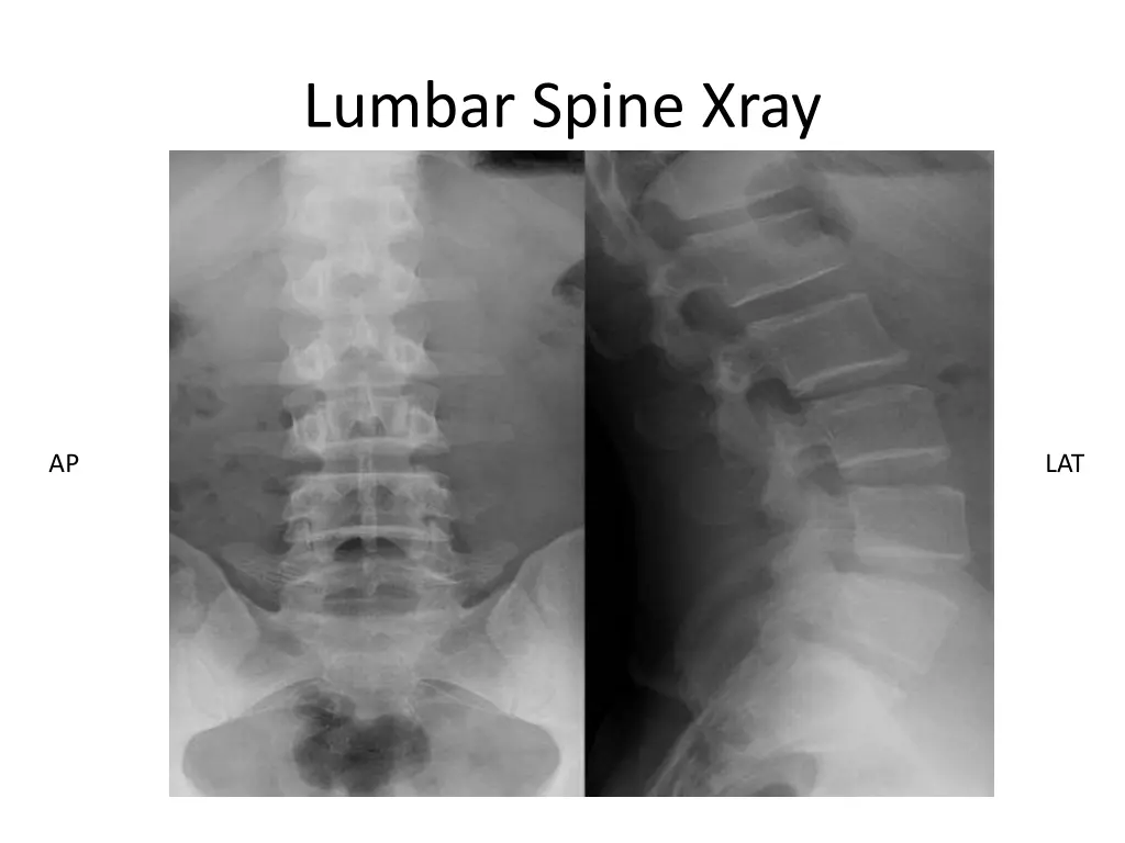 lumbar spine xray