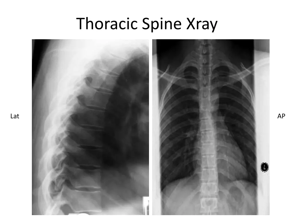 thoracic spine xray