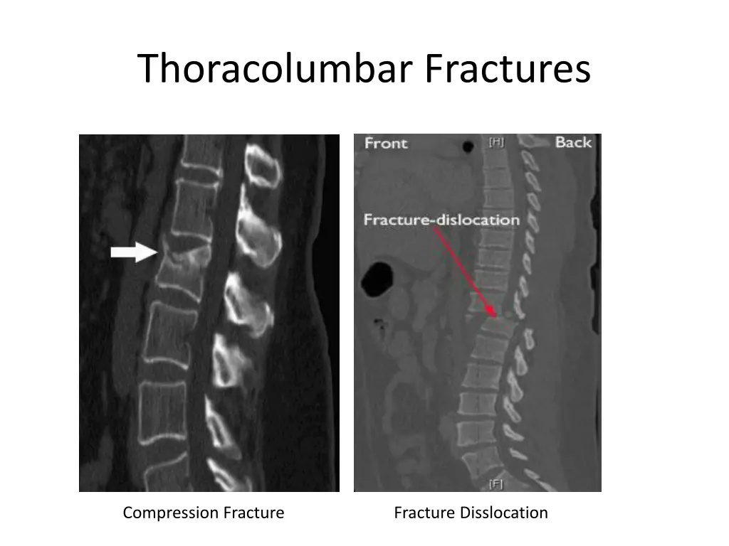 thoracolumbar fractures