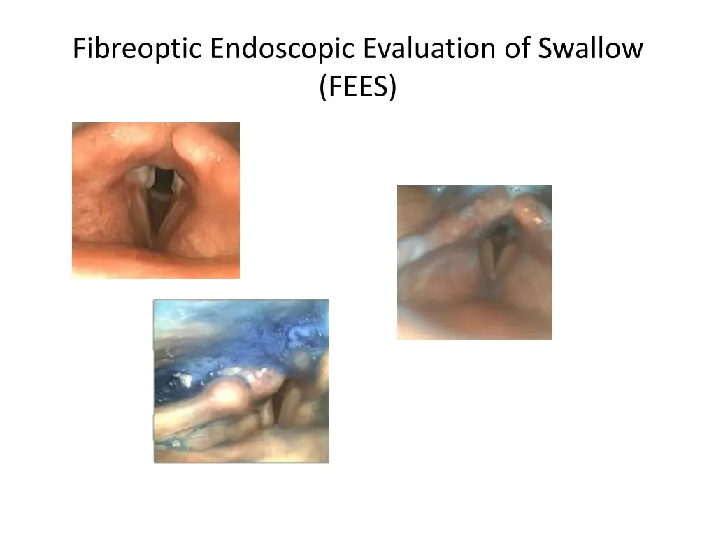 fibreoptic endoscopic evaluation of swallow fees