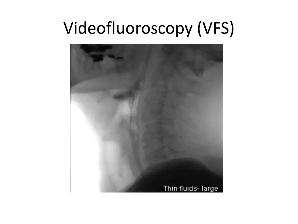 videofluoroscopy vfs