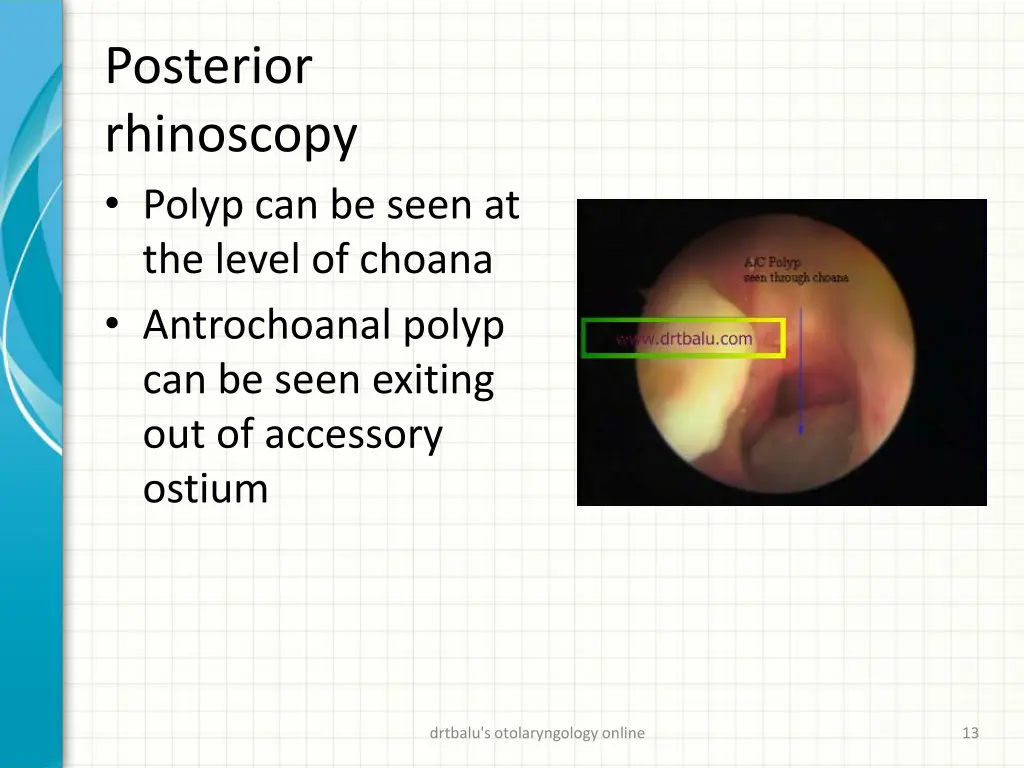 posterior rhinoscopy polyp can be seen