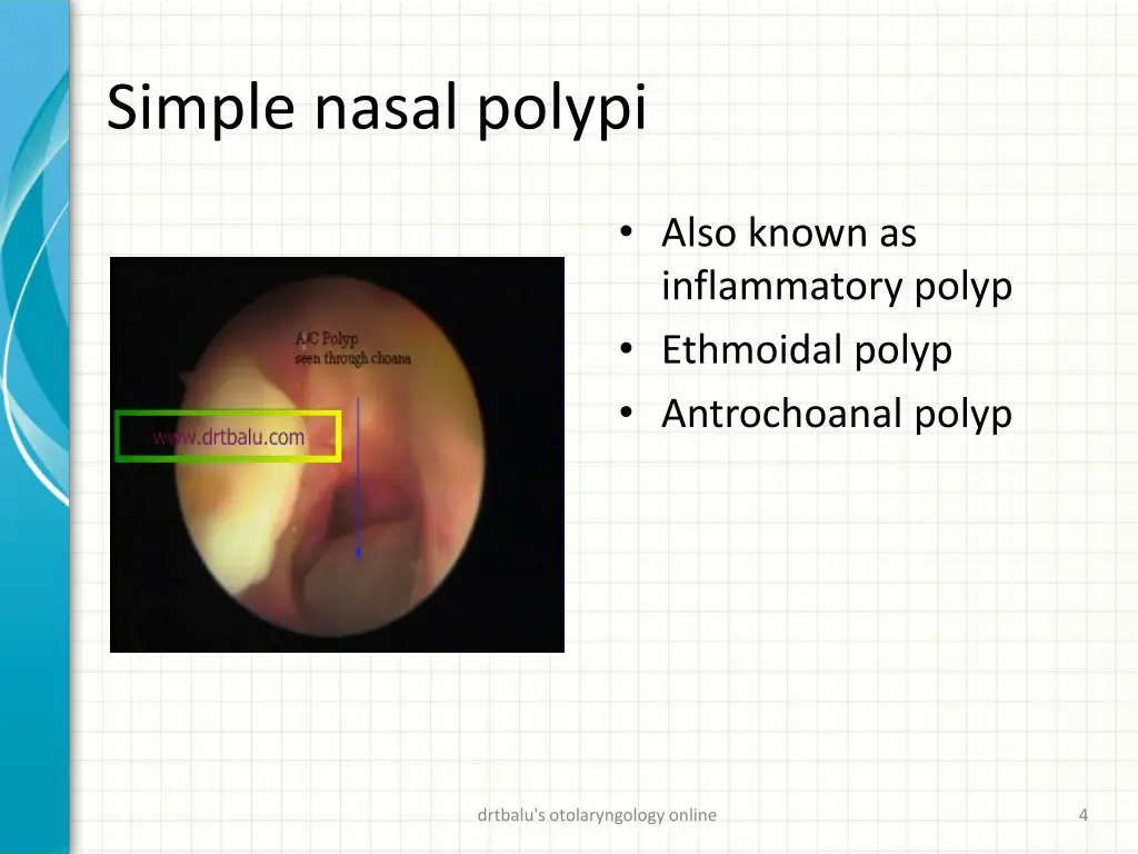 simple nasal polypi