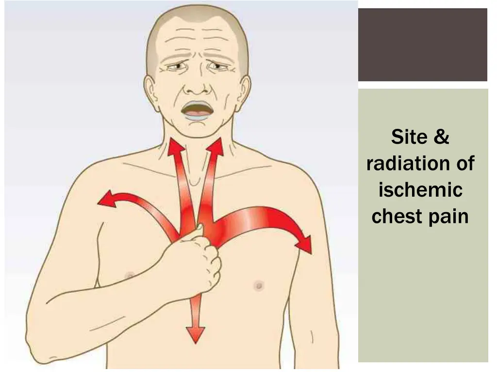 site radiation of ischemic chest pain