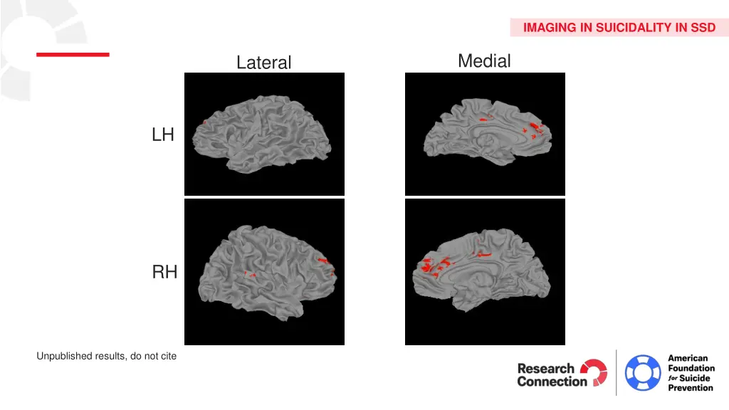 imaging in suicidality in ssd 1