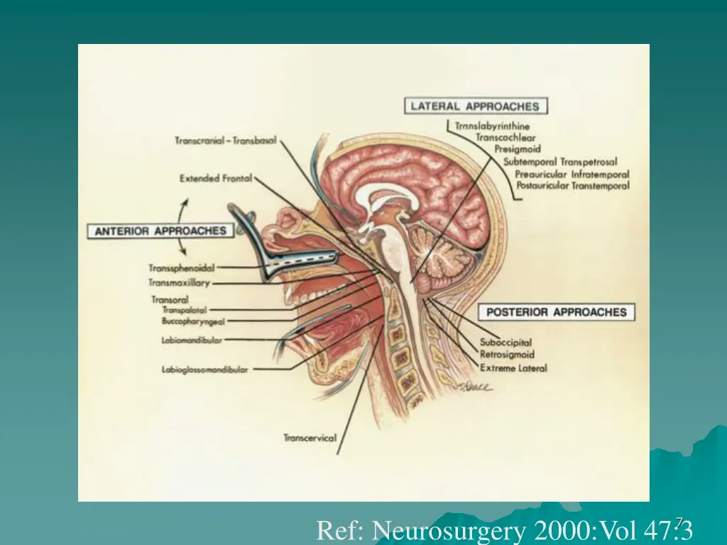 ref neurosurgery 2000 vol 47 3