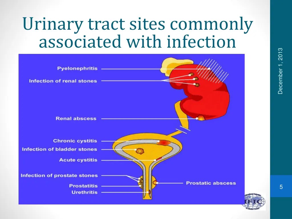 urinary tract sites commonly associated with