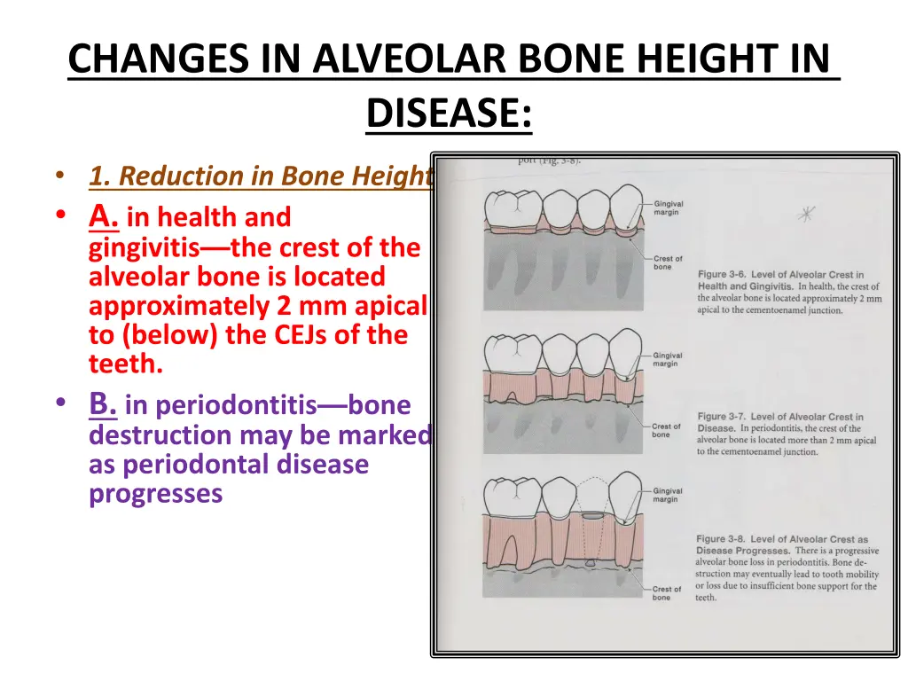 changes in alveolar bone height in disease