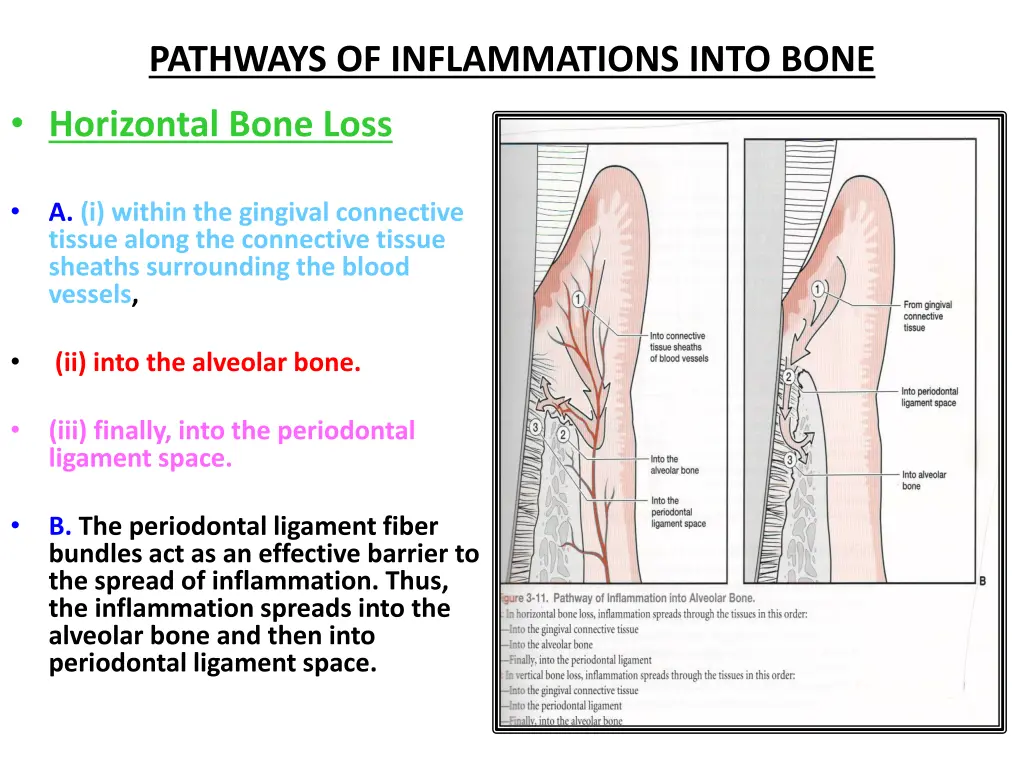 pathways of inflammations into bone horizontal