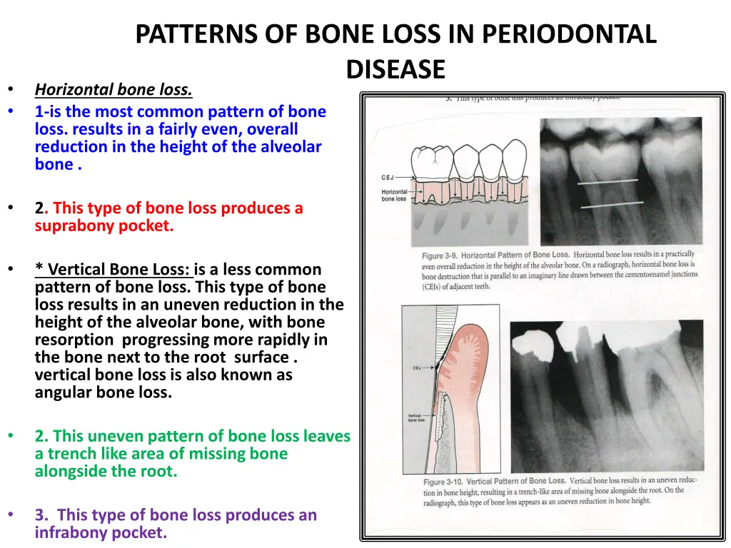 patterns of bone loss in periodontal disease