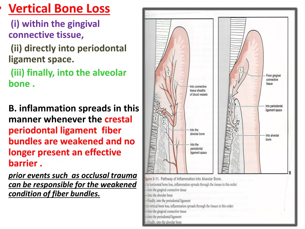 vertical bone loss i within the gingival