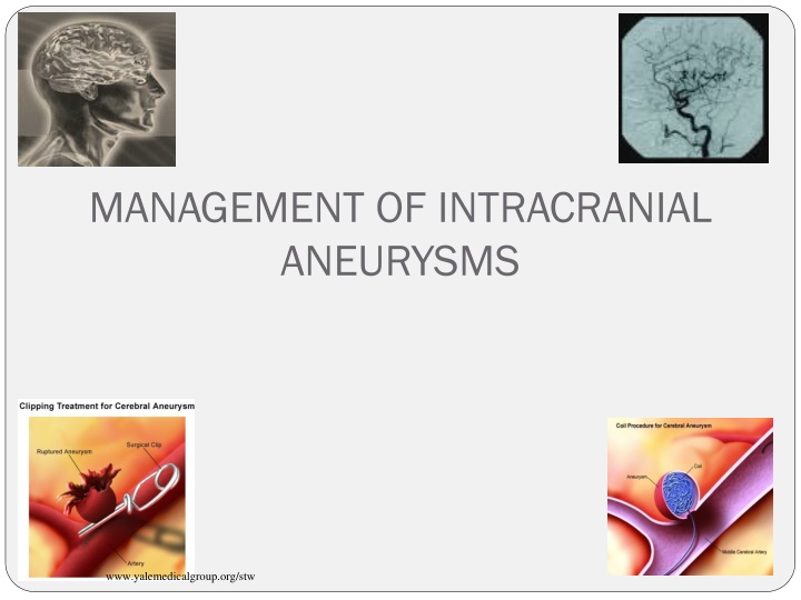 management of intracranial aneurysms