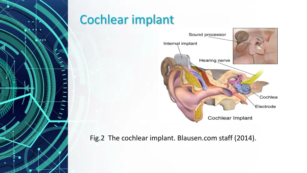 cochlear implant