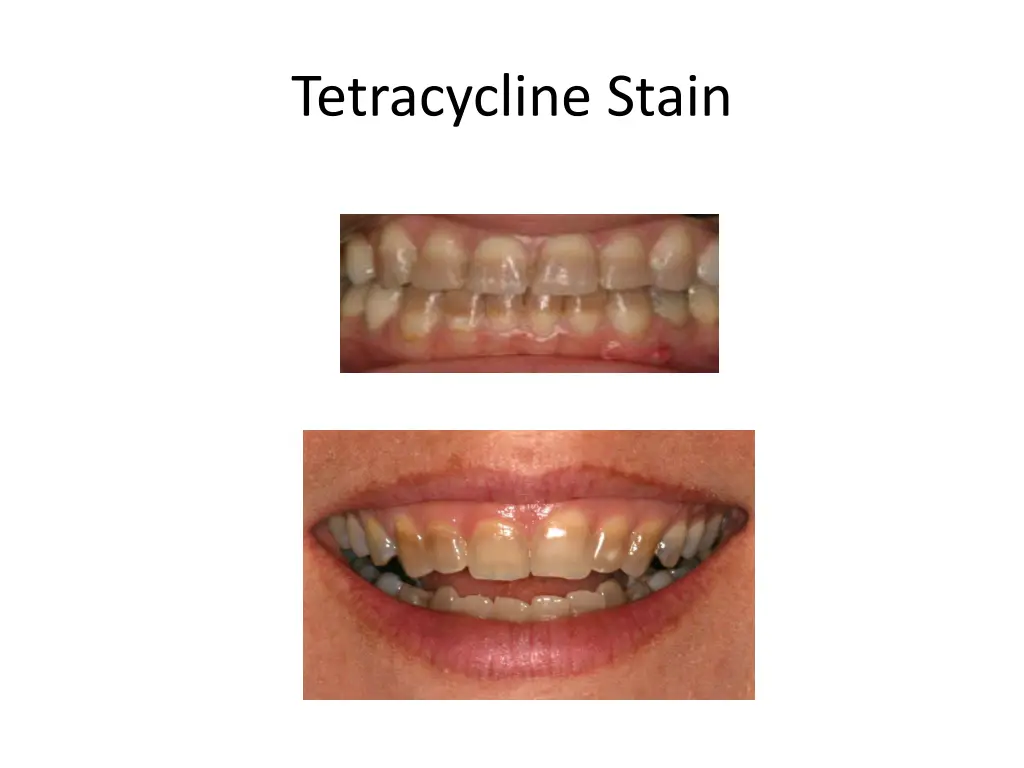 tetracycline stain 3