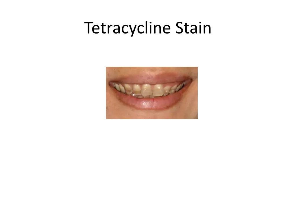 tetracycline stain 4