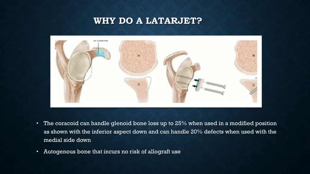 why do a latarjet