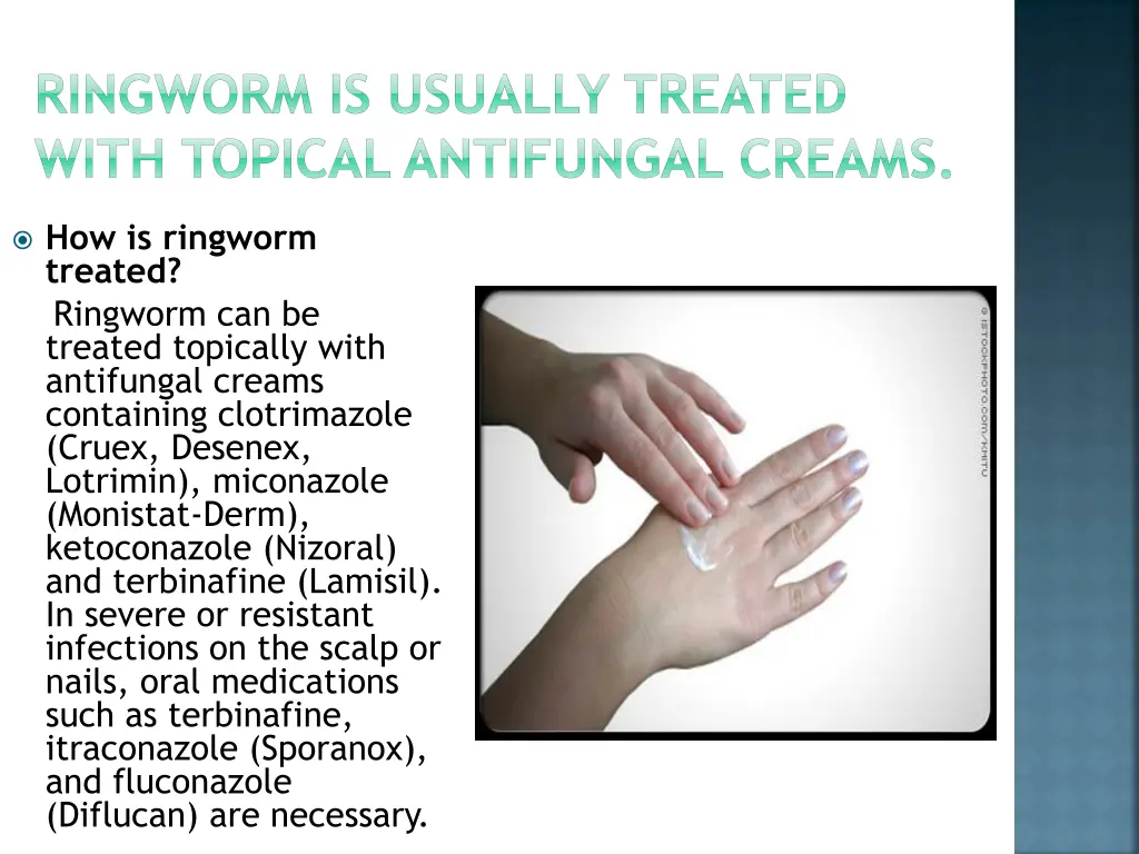 ringworm is usually treated with topical