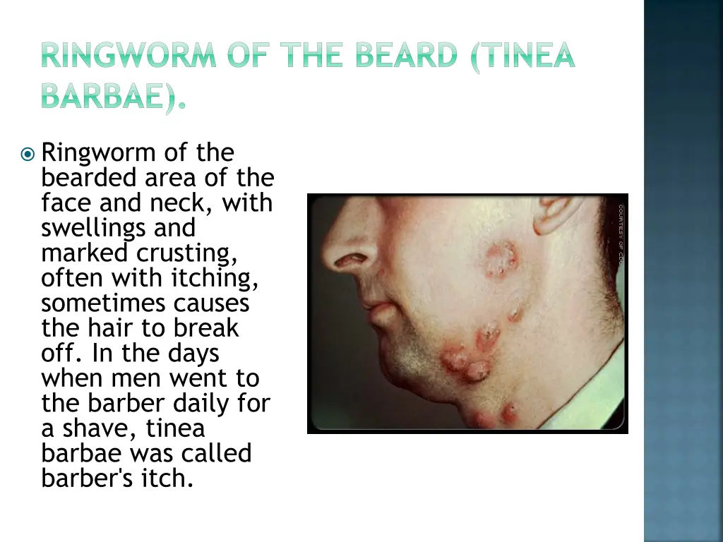 ringworm of the beard tinea barbae