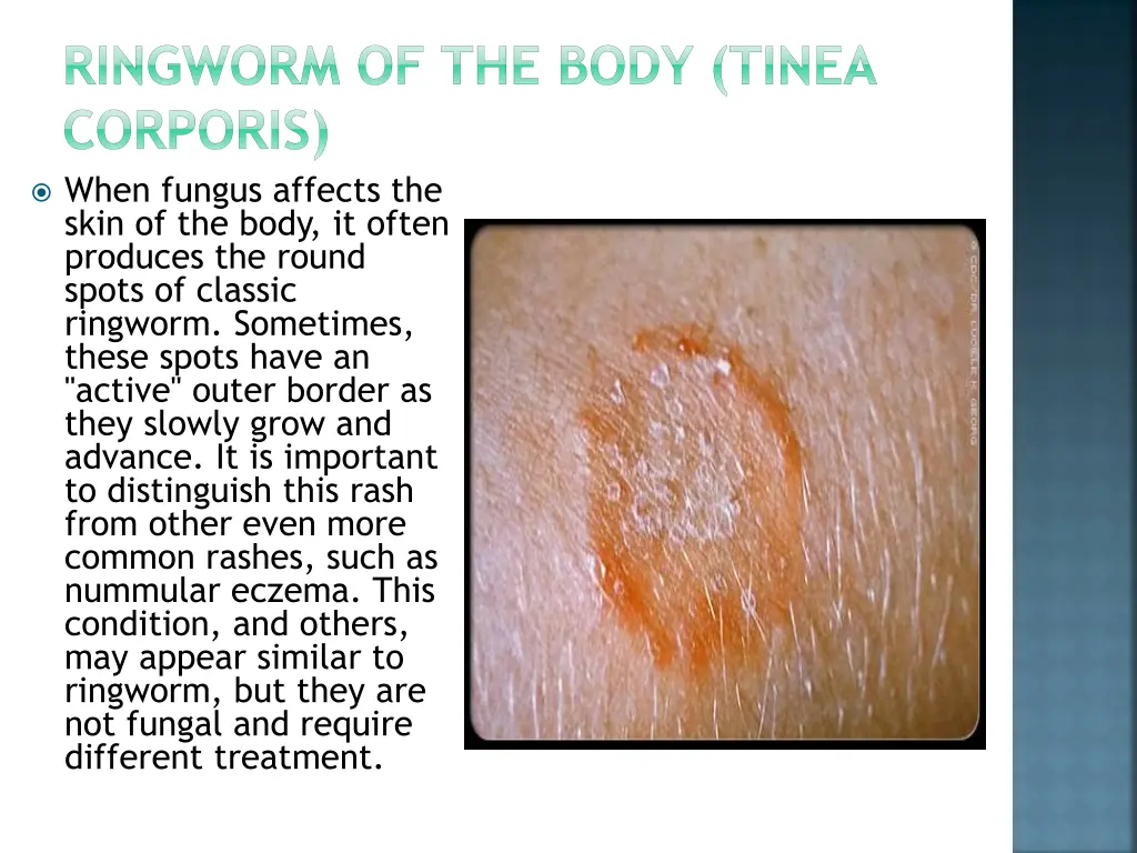 ringworm of the body tinea corporis when fungus