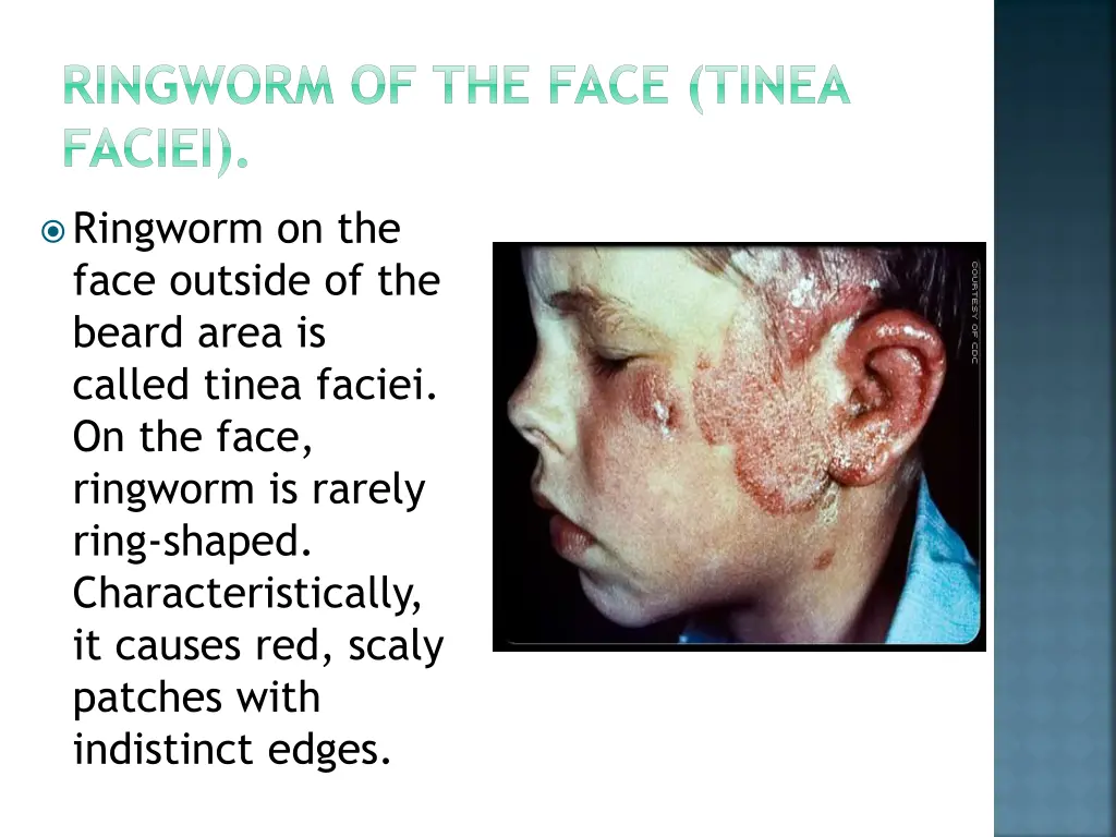 ringworm of the face tinea faciei