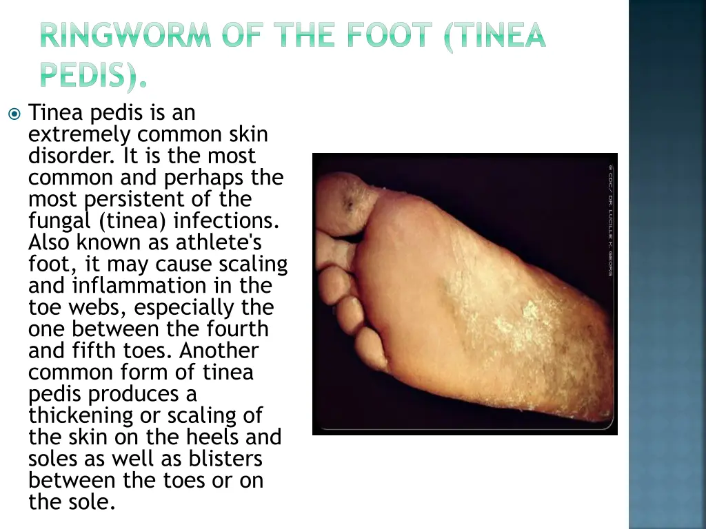 ringworm of the foot tinea pedis tinea pedis