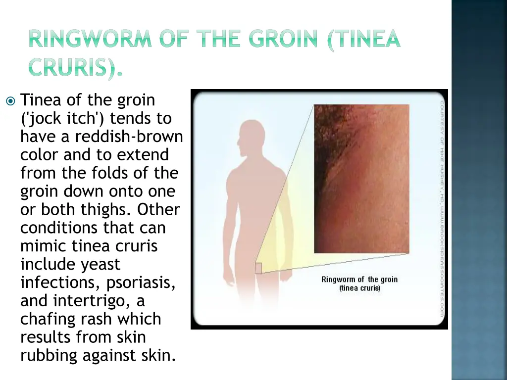 ringworm of the groin tinea cruris