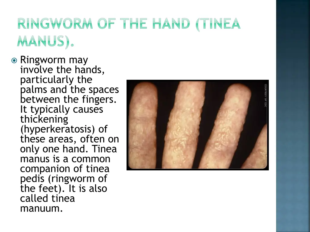 ringworm of the hand tinea manus