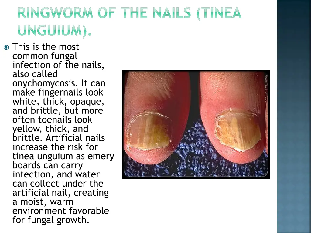 ringworm of the nails tinea unguium this