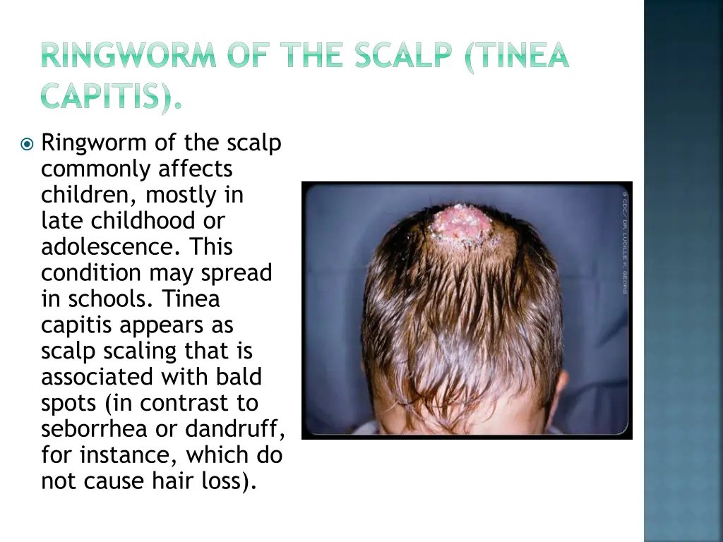 ringworm of the scalp tinea capitis