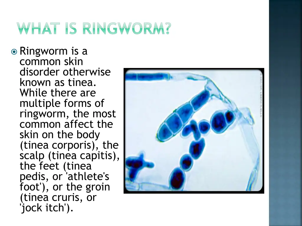 what is ringworm