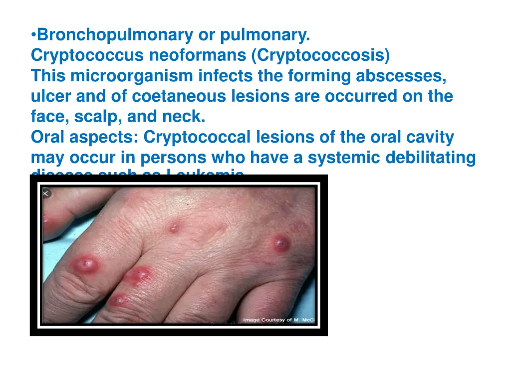 bronchopulmonary or pulmonary cryptococcus