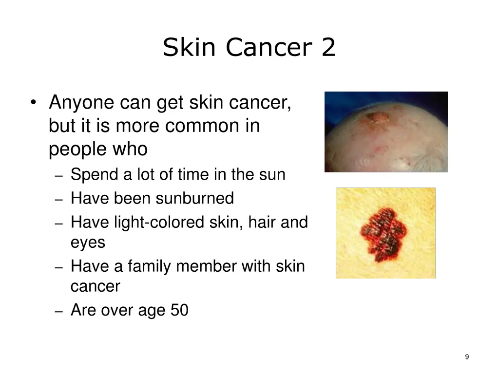 skin cancer 2