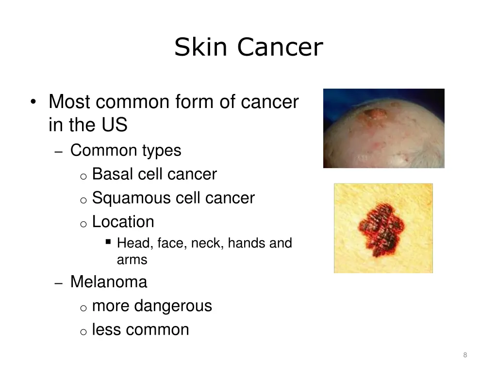 skin cancer