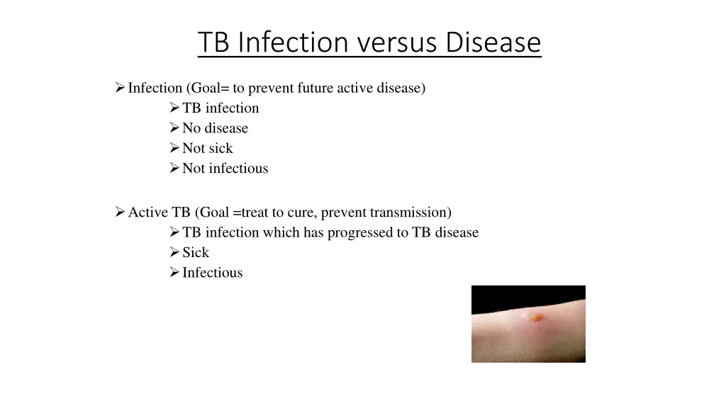 tb infection versus disease