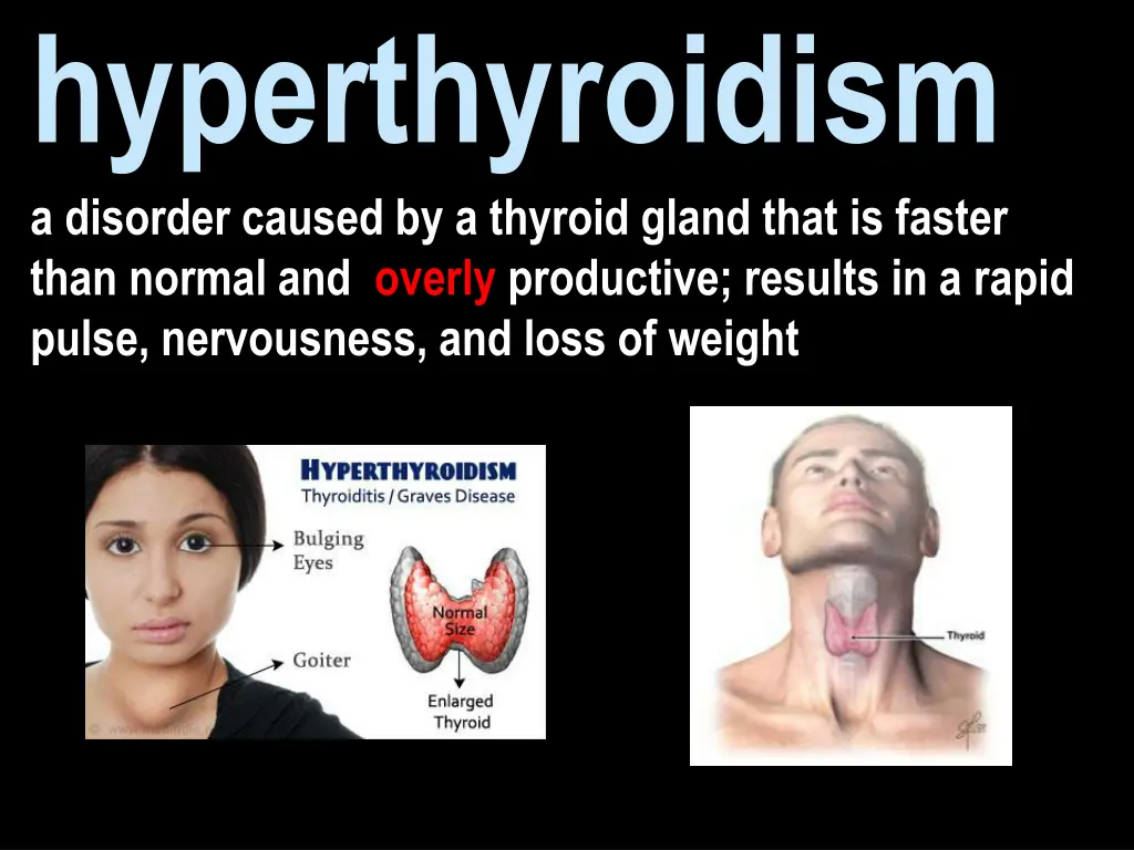 hyperthyroidism a disorder caused by a thyroid