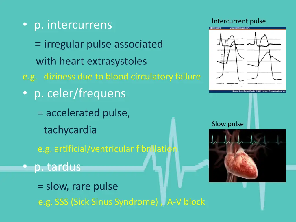 p intercurrens irregular pulse associated with