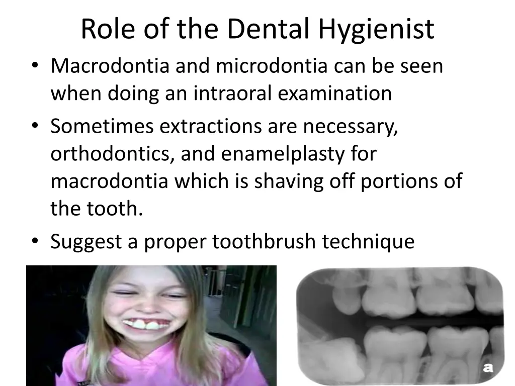 role of the dental hygienist macrodontia