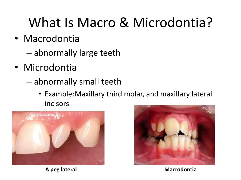 what is macro microdontia macrodontia abnormally