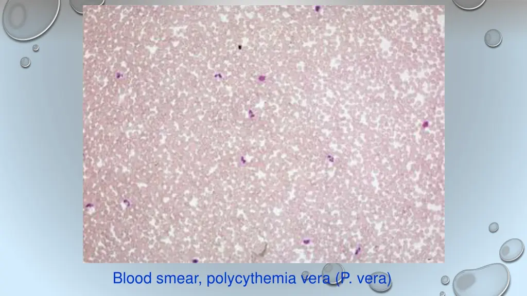 blood smear polycythemia vera p vera