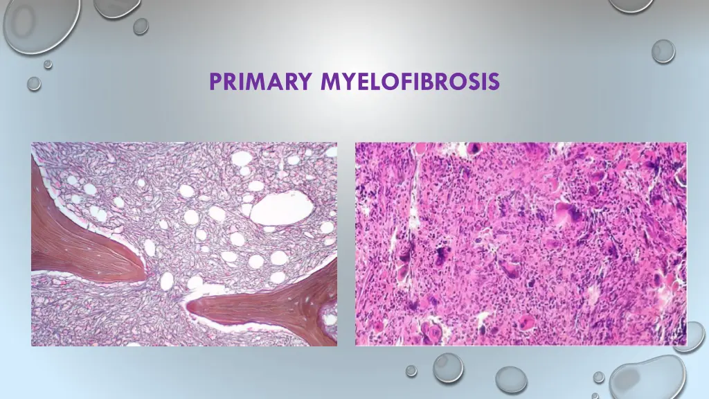 primary myelofibrosis 6