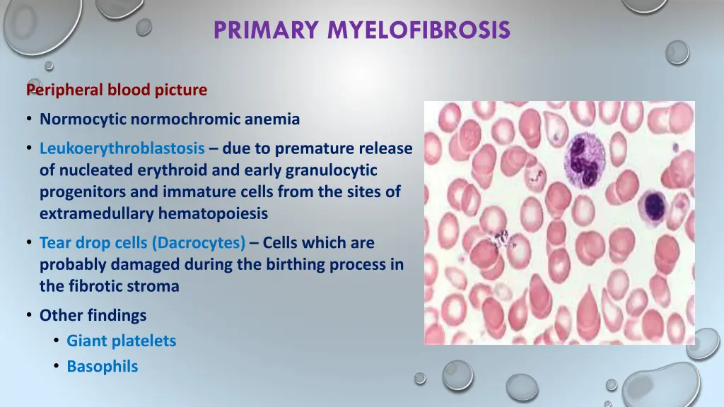 primary myelofibrosis 8