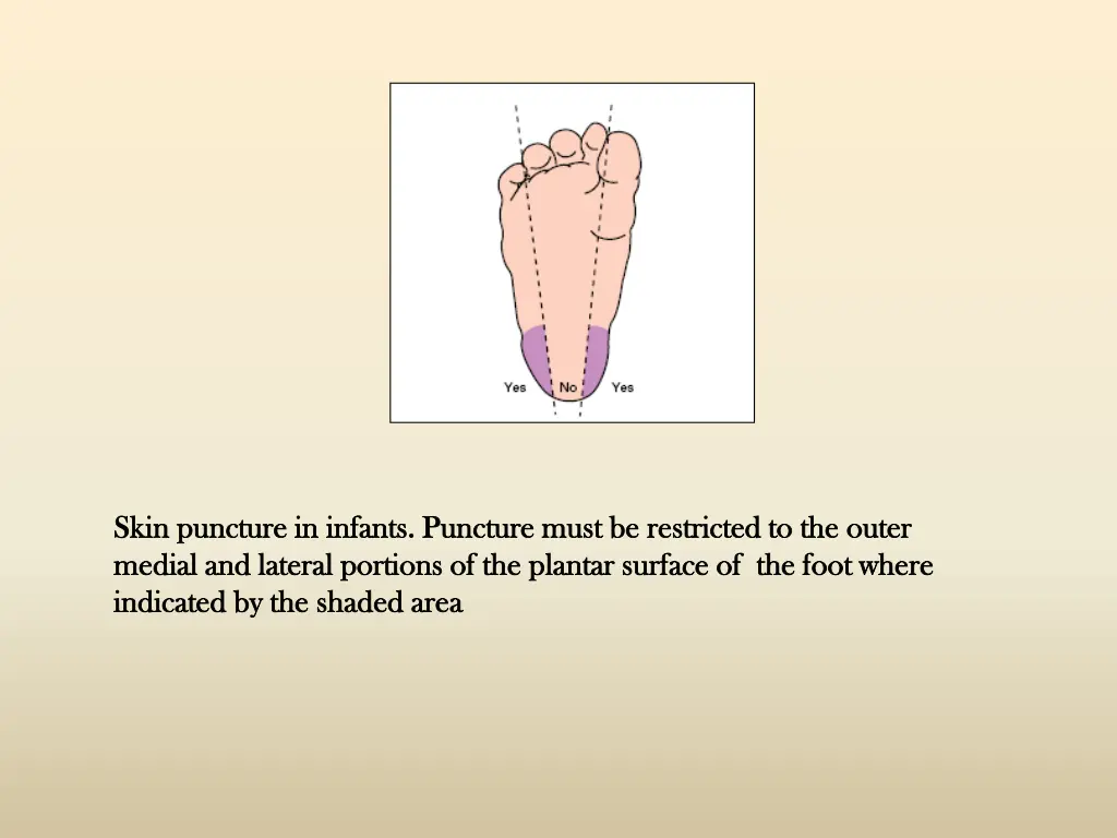 skin puncture in infants skin puncture in infants