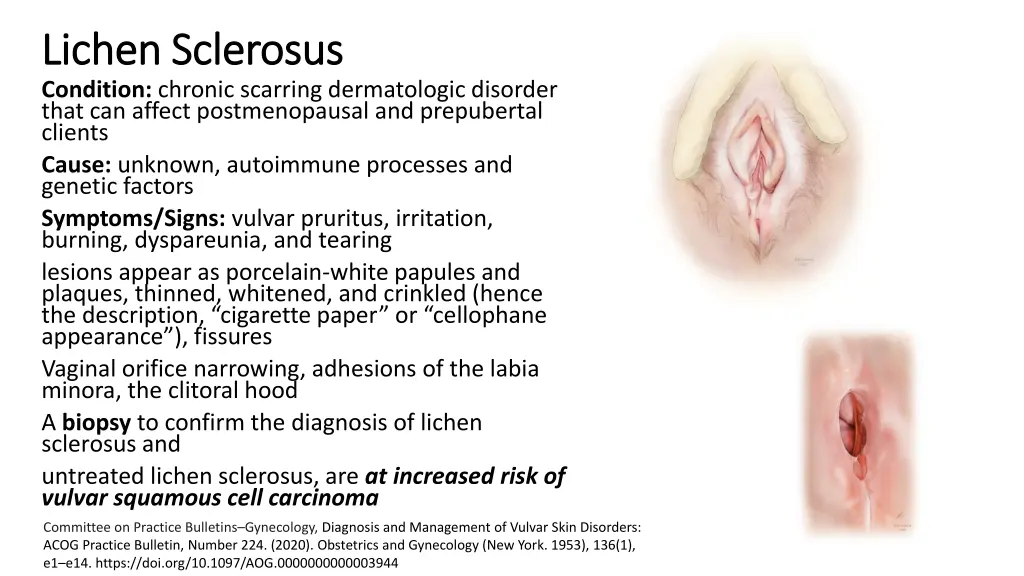 lichen lichen sclerosus sclerosus condition