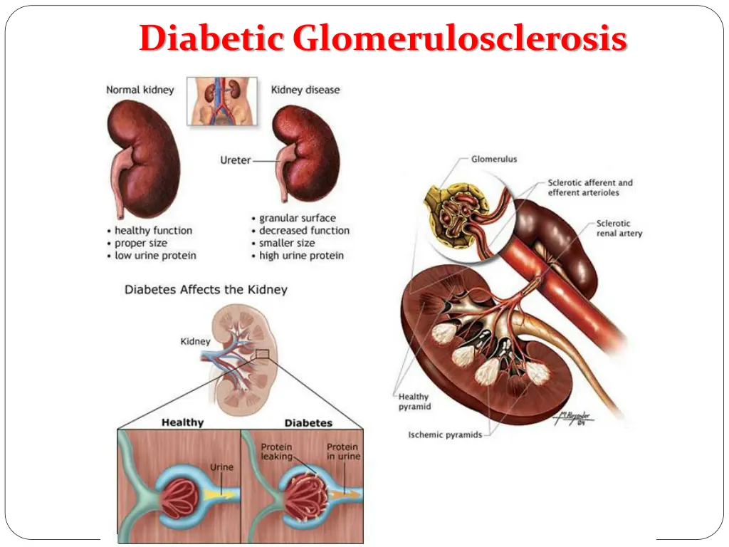 diabetic glomerulosclerosis 1