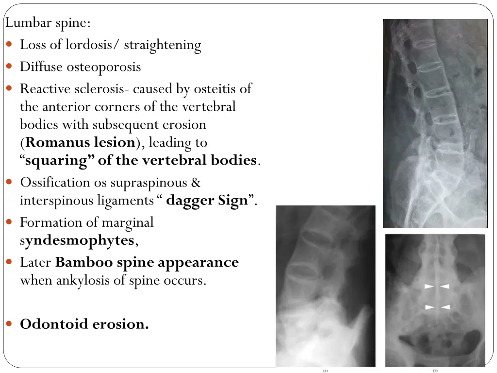 lumbar spine loss of lordosis straightening