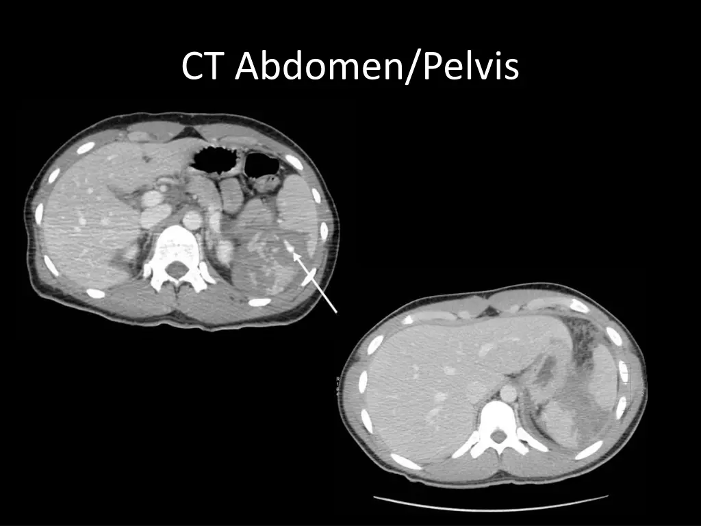 ct abdomen pelvis