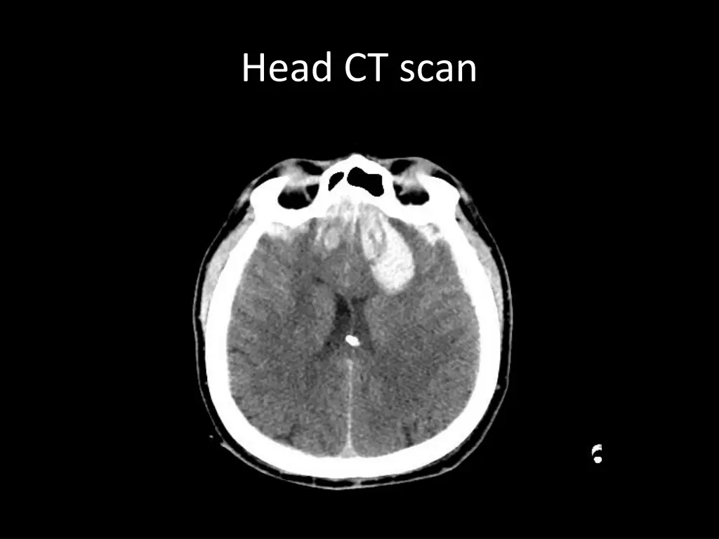 head ct scan